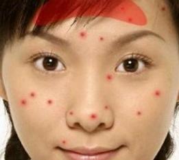 春季长痘痘注意事项有哪些,春天做好4件小事让痘痘不再复苏