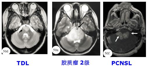 医学干货：瘤样炎性脱髓鞘病与胶质瘤、PCNSL临床、影像鉴别