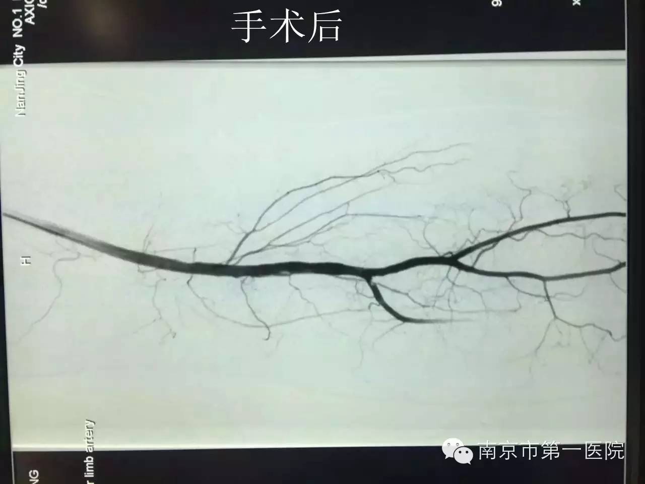 腿中风能治好吗,腿中风后遗症怎么样的