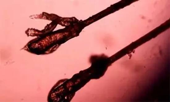 杭州一男子因眼睛奇痒就医，睫毛里竟爬出3条虫！