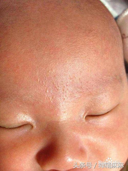 怎么区分热痱子湿疹过敏,夏天起痱子是和荨麻疹过敏有关吗