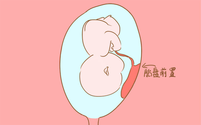 边缘性前置胎盘28周出血,为什么28周前不诊断前置胎盘