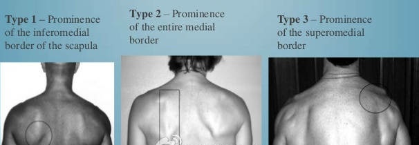 纠正肩胛骨突出的办法视频,如何矫正肩胛骨翘起来