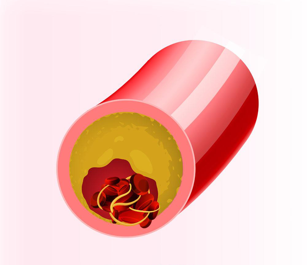 高血脂小偏方,高血脂小偏方倪海厦