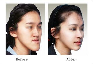 地包天面相是福相还是缺陷,地包天是福相