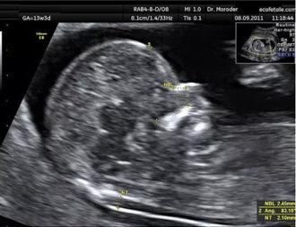 怀孕2个月了做腹部b超看得清楚吗,整个孕期大概做多少次b超