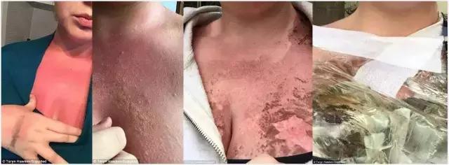 香蕉船防晒霜儿童可以用吗,香蕉船防晒霜用了脸刺痛