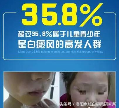 白癜风数据,白癜风正在处于发展高峰期怎么办