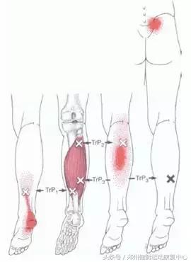 跟腱炎的治疗最好的方法,跟腱炎做什么运动恢复视频