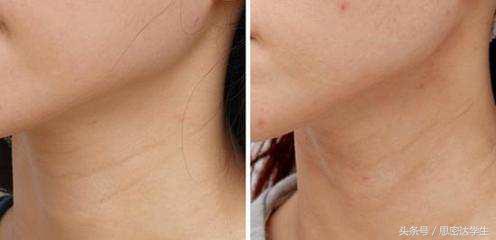 颈部皮肤松弛的解决办法,颈纹很深怎么办15岁男生