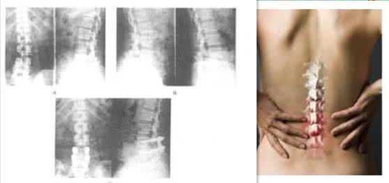 腰椎病骨质增生正骨手法,腰椎骨质增生怎么按摩治疗比较好