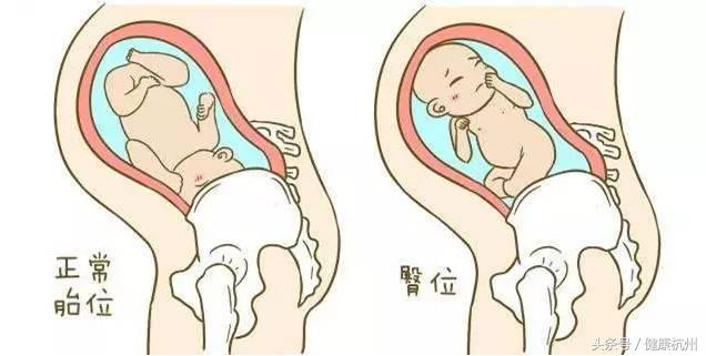 臀位宝宝乾坤大挪移,胎儿臀位乾坤大挪移
