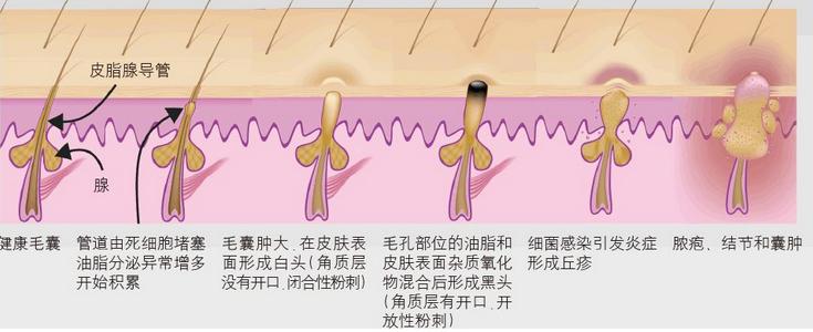 祛痘很多次都不见效,祛痘一瓶搞定