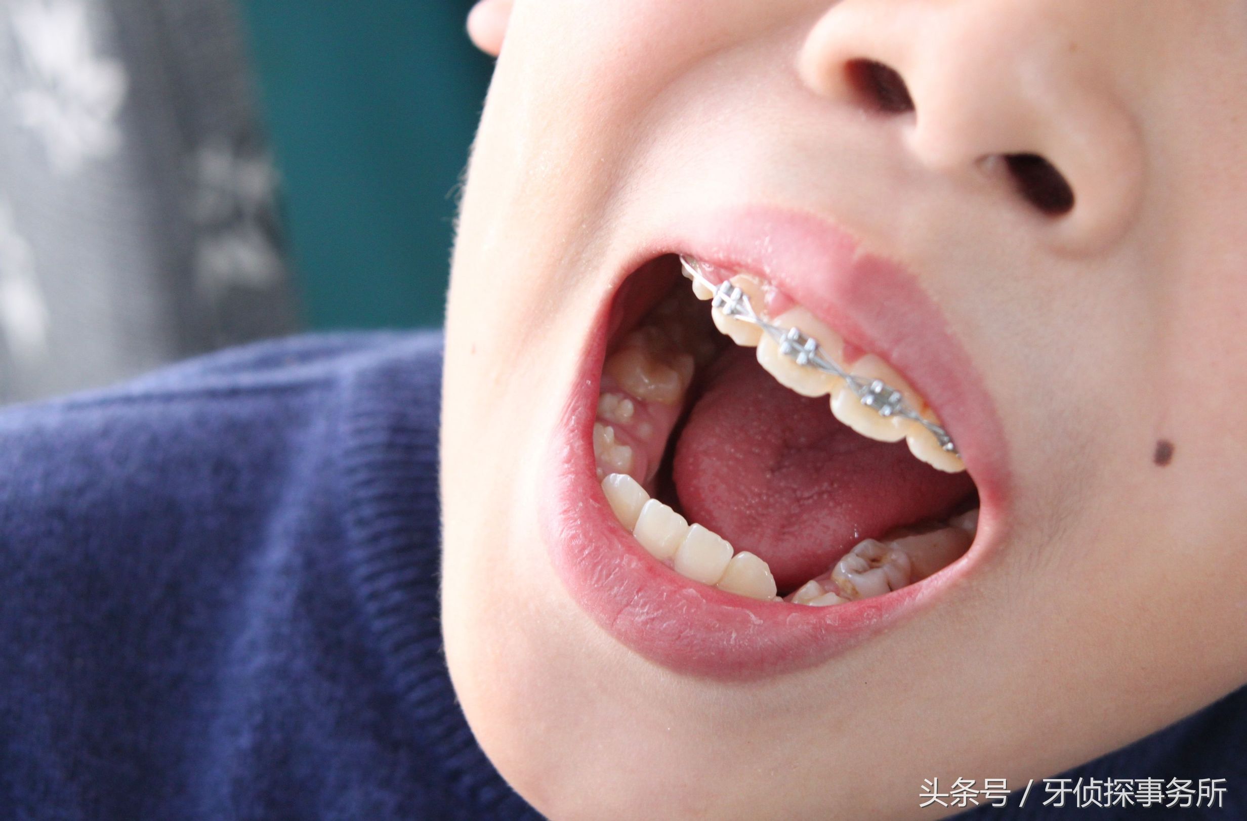 牙齿不整齐跟饮食有关吗,牙齿长乱了说话清楚吗