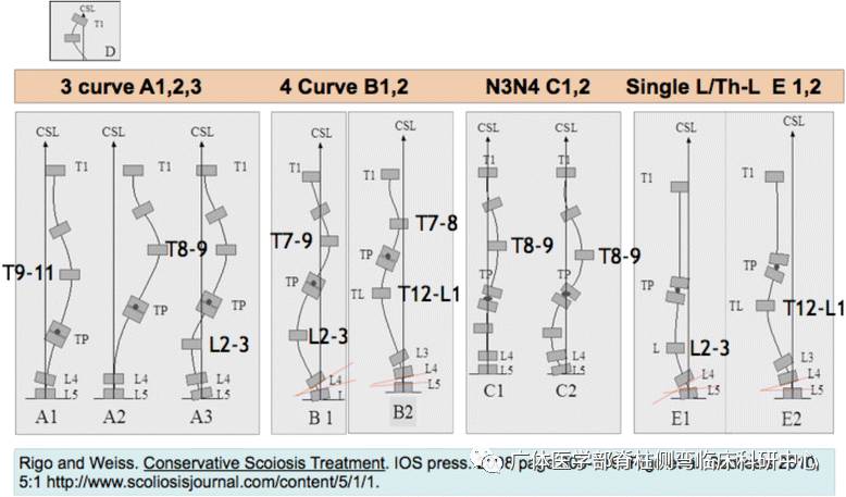 脊柱侧弯暑期训练营招募,脊柱侧弯夏令营视频