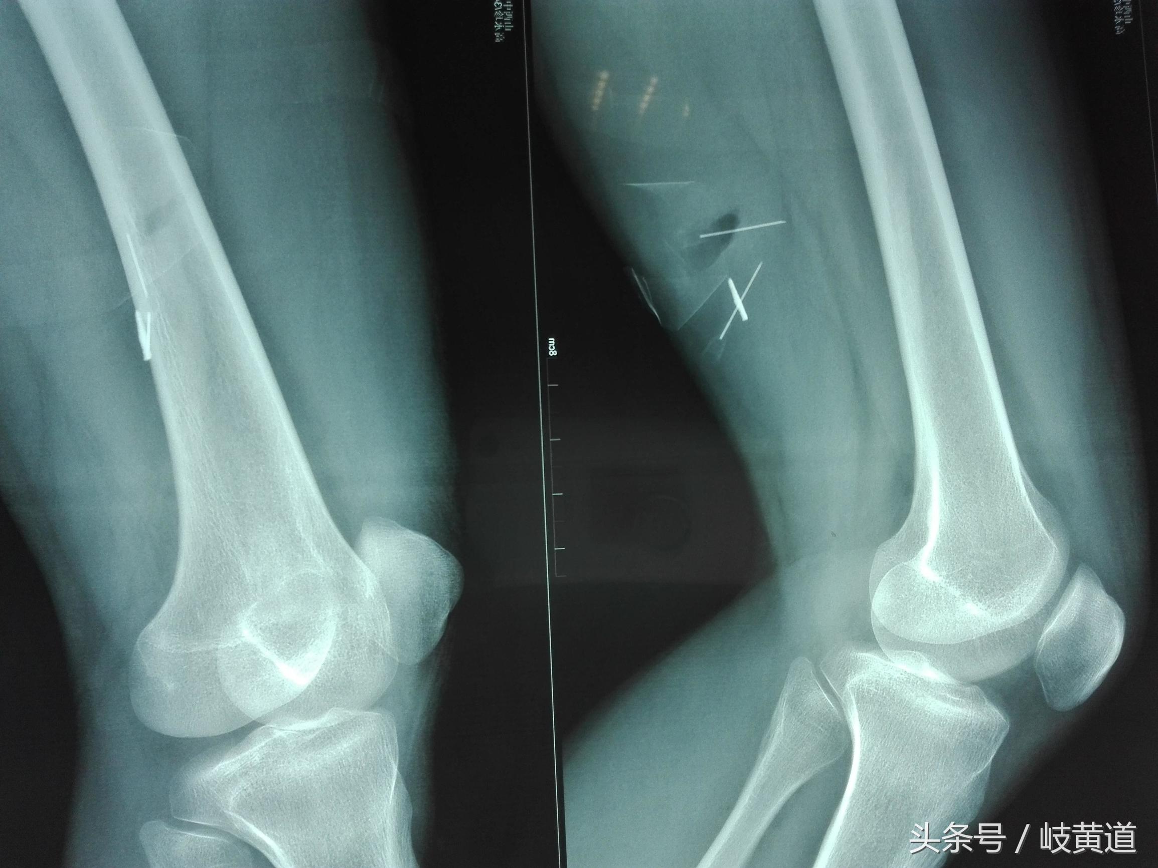 钢渣扎进男子大腿 医生手术2小时取出