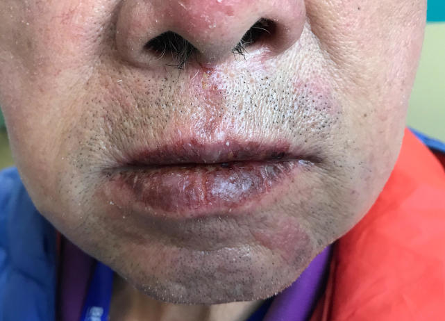 得了皮肤病不要怕,五种常见的皮肤病一分钟教你应对