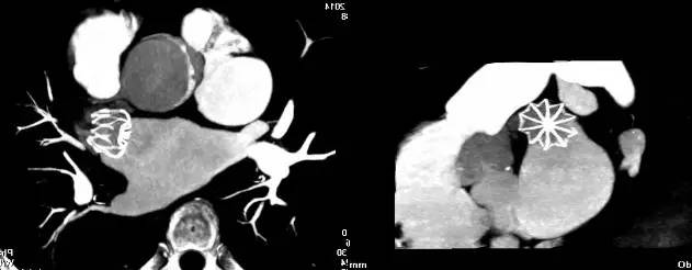 「病例」80岁房颤患者抗凝治疗后反复咯血，咋办？