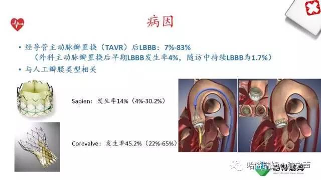 「心声」从机制到临床，一起认识左束支阻滞！