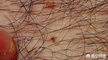 夏季多发皮肤病有哪些？什么是阴毛囊炎？