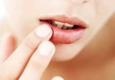 春季烂嘴角是怎么回事,春天烂嘴角怎样去火