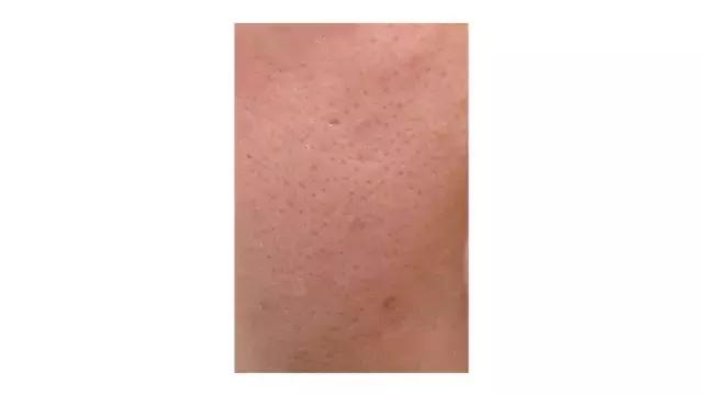 治疗痘印痘坑毛孔粗大的药,男士毛孔粗大痘坑痘印修复
