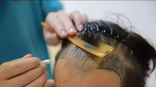 有白发植发和假发哪种好,植发和补发增发哪个好