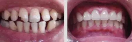 小孩牙齿缝隙大是什么原因,40岁女性牙齿缝隙变大是什么原因