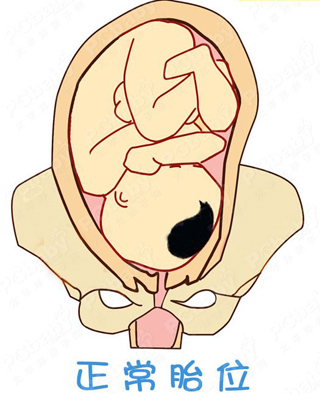 胎位不正怎么纠正最安全,骨缝开了胎位不正有什么方法矫正