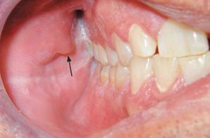 口腔里的“假癌症”(口腔科普第21期)