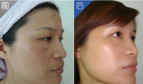 脸上大片褐斑怎么祛除,脸上有褐斑怎么去除最有效