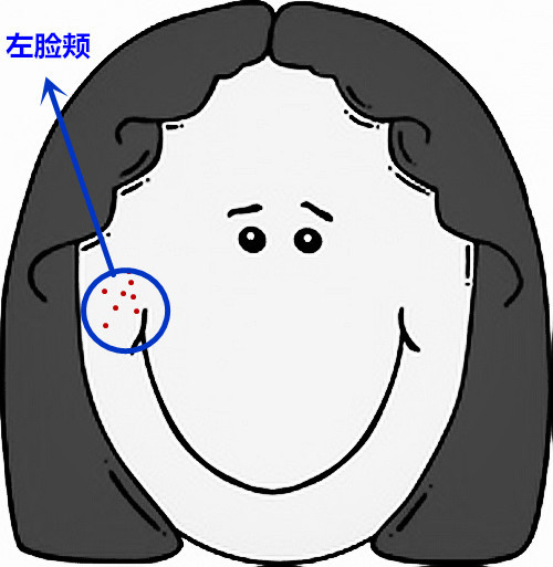 超全面面部痘痘分析图文，了解身体状况！