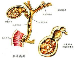 爱吃麻辣烫的女生,胆囊结石取出80多颗