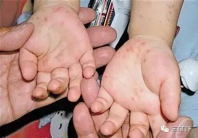 手足口病防治知识发朋友圈,预防手足口病健康课大班