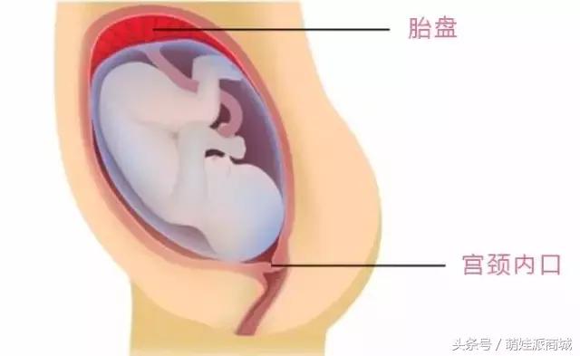 孕妇胎盘低怪谁,孕妇检查胎盘低是怎么回事