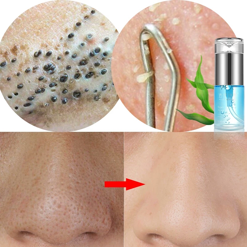 全面解析粉刺解决方法大全,教你几招认识痘痘才能真正根治