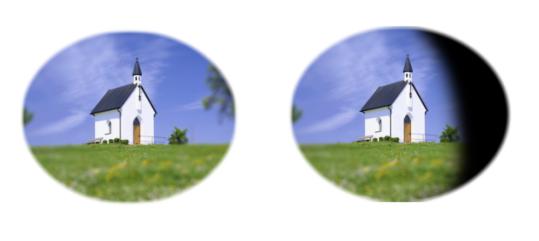 视网膜脱落严重吗,视网膜脱离属于眼部的什么疾病