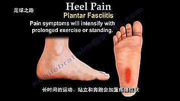 足跟痛最常见病因,足跟痛警惕四种疾病