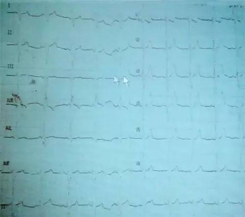 心力衰竭病例分析题及答案,心力衰竭靠什么诊断证明