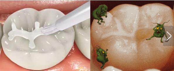 宝宝长虫牙啦正在换牙要怎么办,儿童漱口水可以预防虫牙