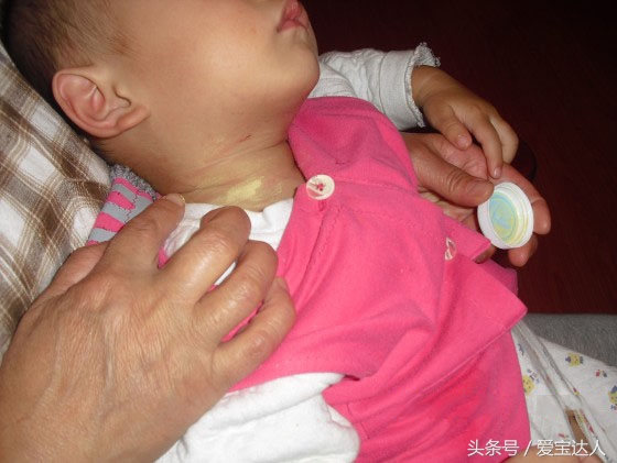 闷热天气小孩出汗怎么办,冬天宝宝淹脖子怎么办