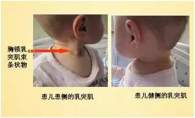斜颈如何早发现,儿童斜颈怎么发现