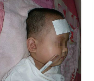 感冒发烧引起小儿癫痫发作怎么办,小孩发烧导致癫痫是先天还是后天