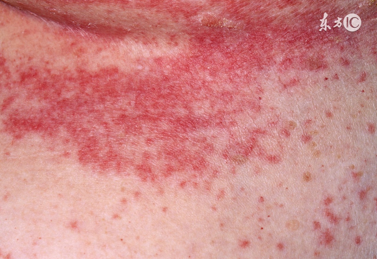 湿疹特别痒只能靠打针该怎么办,湿疹太痒了偏方