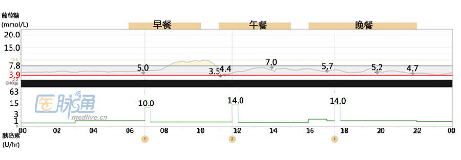 胰岛素泵动态监测血糖,泉信济南