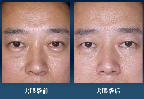 切除眼袋是唯一解决眼袋的方法,眼袋切除方法有哪些