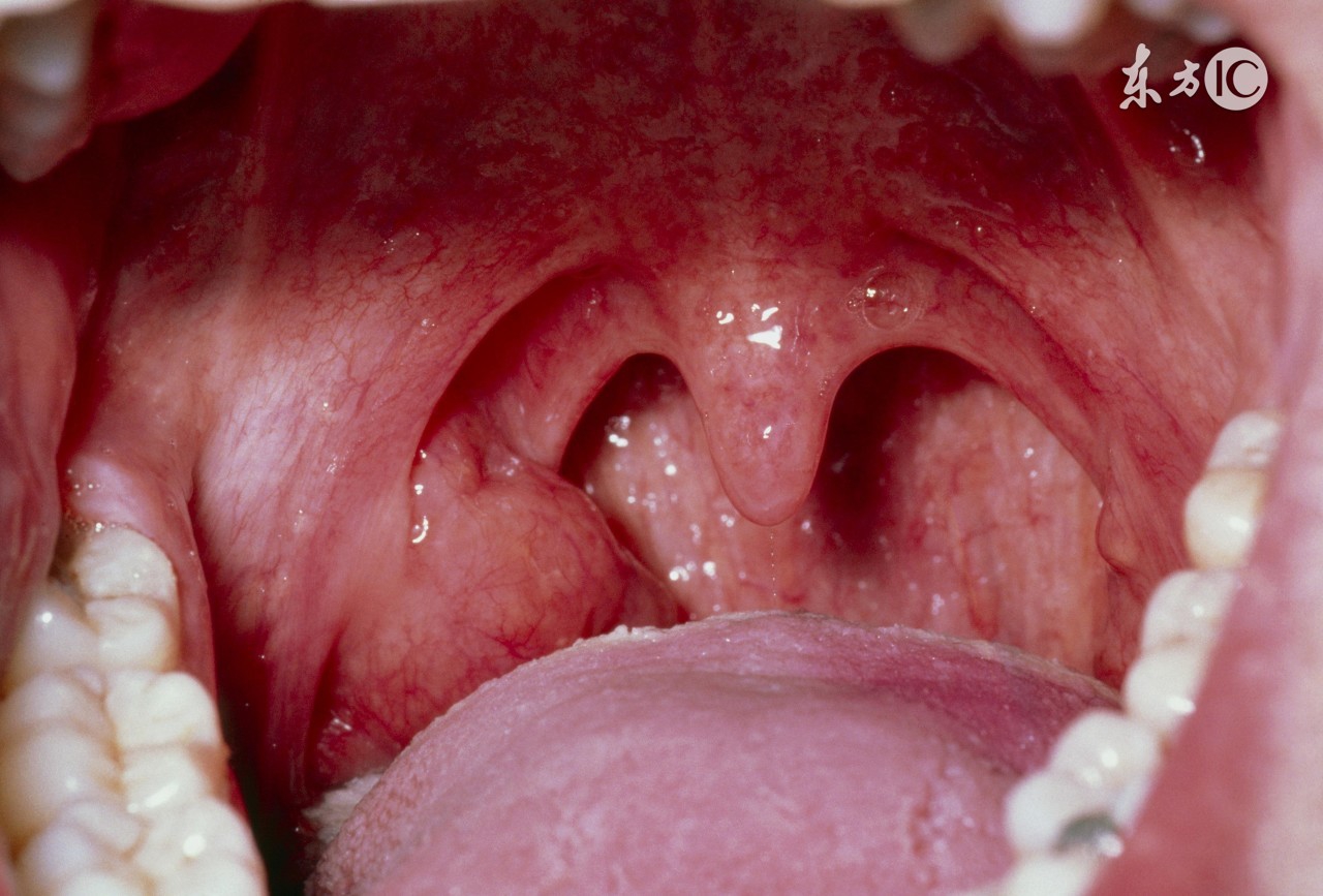 扁桃体能割一边吗,扁桃体能回缩吗