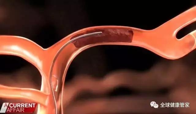 澳洲治疗中风可怕副作用,澳洲十大黑科技药