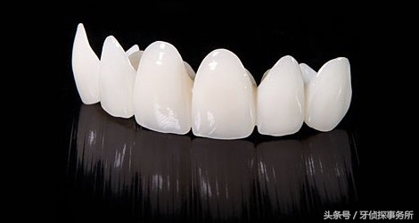 烤瓷牙和全瓷牙的区别和寿命,一颗全瓷牙冠两千贵吗