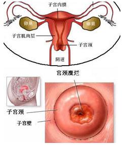 哪些妇科疾病会终身不孕,妇科的炎症会导致不孕吗